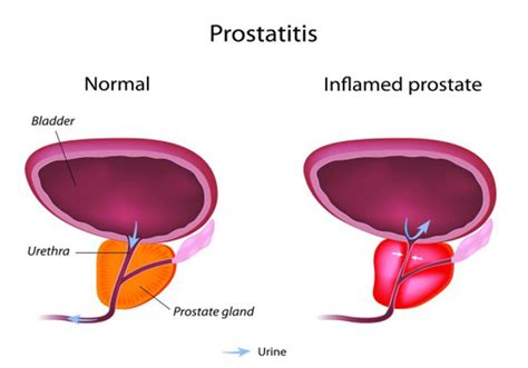 Possible causes of prostatitis | Men's Health articles | Family Health center | SteadyHealth.com