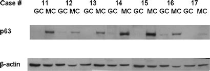 Distribution of p63 protein in giant cell tumor of bone. Total cell ...