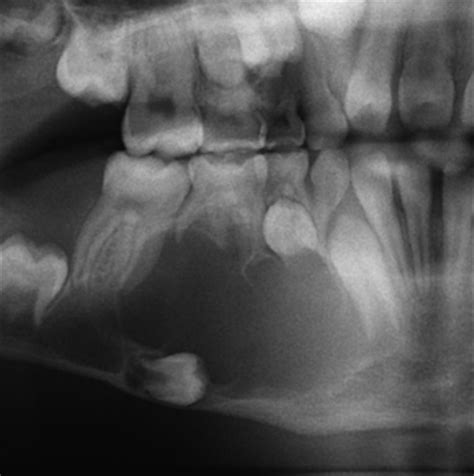 الكيس القرني السني المنشأ Odontogenic Keratocysts - موقع فكين