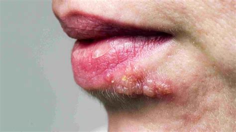 Pimples On The Tongue: How To Get Rid Of Them