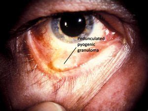 Pyogenic Granuloma Eye Treatment