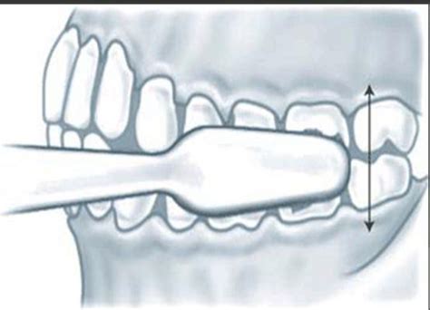 Figure 4 from Causes laceration of the gingiva 2 ) Modified Bass Method / Sulcus Cleaning Method ...