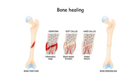 How To Tell If A Broken Bone Is Healing