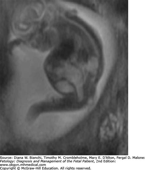 Persistent Cloaca | Obgyn Key