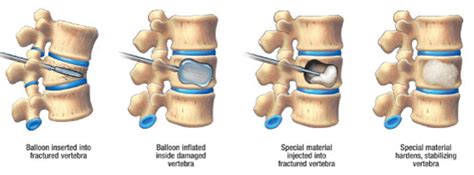 kyphoplasty-explained - Complete Spine and Pain Care