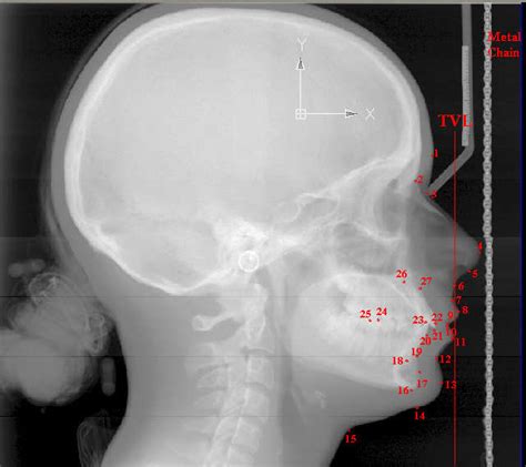 5. Cephalometric Landmarks. | Download Scientific Diagram