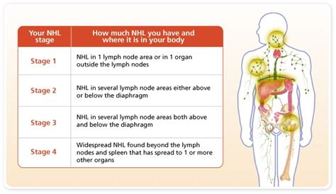 Beating Back Cancer: Understanding NHL