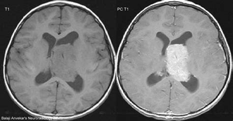 Dr Balaji Anvekar FRCR: Choroid plexus papilloma MRI