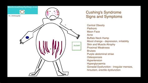 Cushing's Syndrome Signs and Symptoms ( Part 2 ) - YouTube