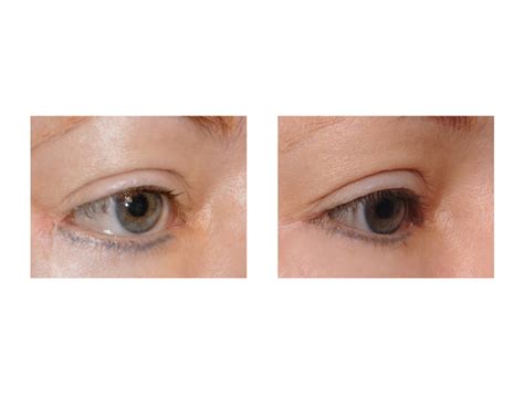 » Blog ArchiveCase Study - Double Hole Lateral Canthoplasty for Ectropion Repair