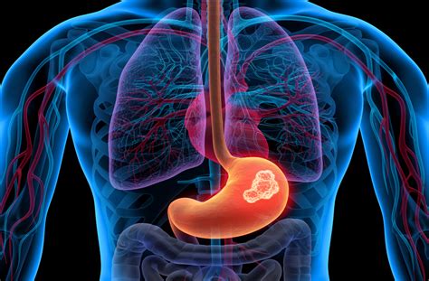 Stomach (Gastric) Cancer - Abramson Cancer Center | Penn Medicine