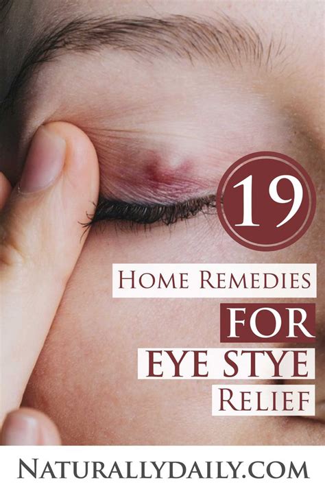 19 Home Remedies for Eye Stye Relief in 2020 (With images) | Sty in eye remedies, Eye stye ...