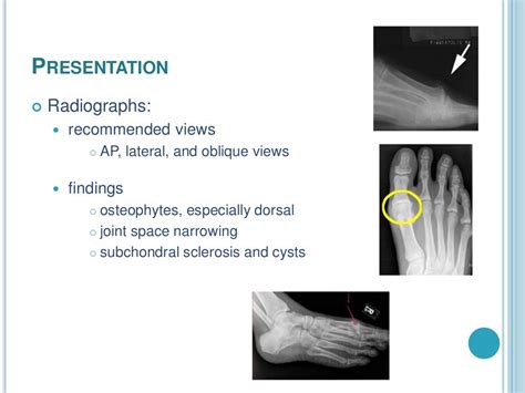 Hallux rigidus