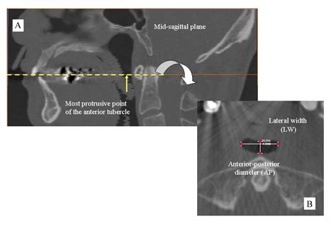 The Relationship between Anterior Tubercle of the Atlas to the Adjacent Oropharyngeal Airway ...