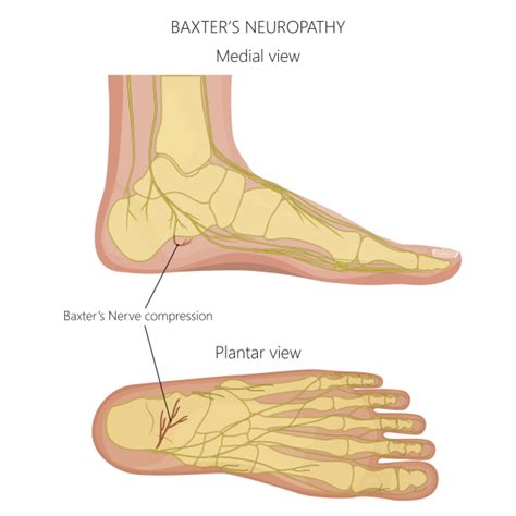 Baxter's Nerve Entrapment: A Cause of Heel Pain - Sport Doctor London