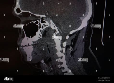 Side view MRI of a human Stock Photo - Alamy