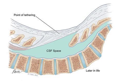 What is a Tethered Spinal Cord? | Barrow Neurological Institute