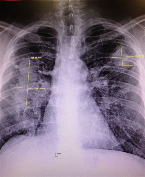 Region’s Black Lung Rates Highest In 25 Years - WOUB Public Media