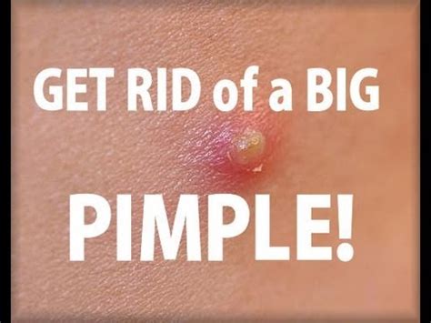 How To Get Rid Of One Big Pimple - Respectprint22