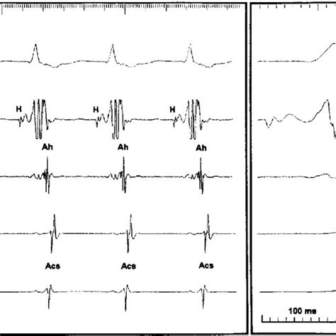 Left: 12 lead ECG of AVNRT with visible retrograde P wave in a woman of... | Download Scientific ...