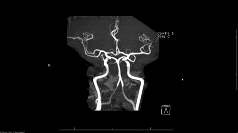 MRA (magnetic resonance angiogram) head radiology search pattern - YouTube