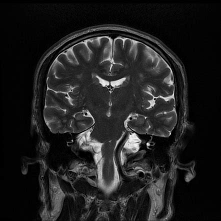 Vertebrobasilar dolichoectasia | Radiology Case | Radiopaedia.org