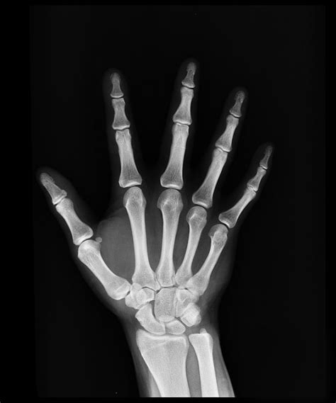 Hand X-Ray