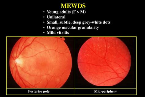 PPT - IDIOPATHIC INFLAMMATORY WHITE DOT SYNDROMES PowerPoint Presentation - ID:1482677