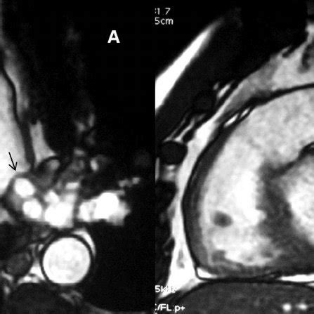 Ultrasound image showing typical multivesicular hydatid cyst in the ...