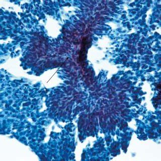 Mild cytological atypia of urothelial cells (arrow) in routine cytology... | Download Scientific ...