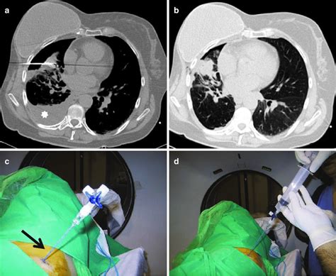 5 Axial CT image shows a pneumothorax during biopsy of the right lung ...