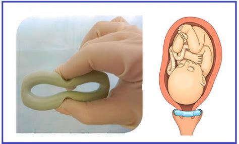 A New Model of Obstetrical Pessary – Prevention and Treatment of ...