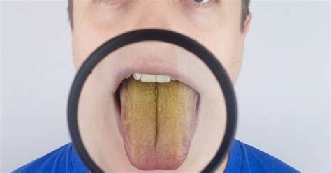 12 Reasons Why Your Tongue Is Green & How To Treat It Safely