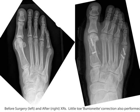 Hallux Valgus Surgery London, UK | Codeine & Diclofenac Hertfordshire