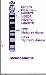 Genetics Blog Assignment: TAY SACH DISEASE: Ramzan Rana