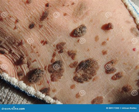 Many Mole on the Skin of Elderly Woman Stock Photo - Image of close, female: 88917308