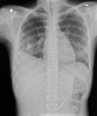 Pulmonary cavity | Radiology Reference Article | Radiopaedia.org