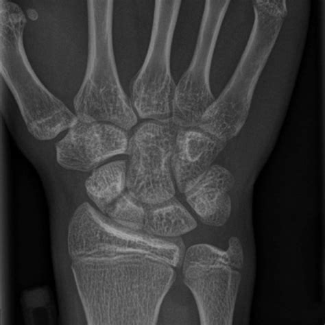 Radiograph of the bilateral wrists, taken four months after surgery,... | Download Scientific ...