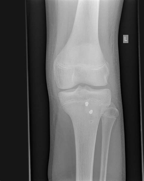 Tibial tuberosity avulsion fracture | Image | Radiopaedia.org