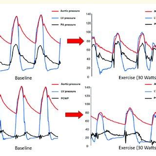 Pulmonary arterial pressure and pulmonary capillary wedge pressure... | Download Scientific Diagram