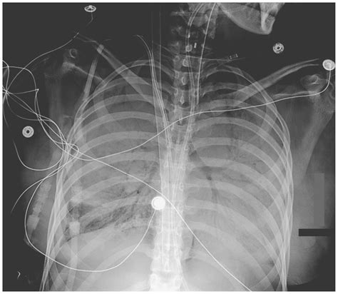 Air Bronchogram | NEJM