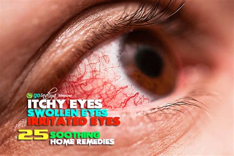 Red, itchy eyes? Home Remedies for Soothing Itchy, Swollen, Irritated Eyes. Cure Eyes Allergies ...
