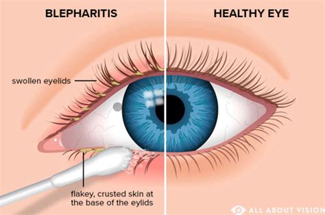 Blepharitis: Prevalence and Symptoms of a Common Eye Condition