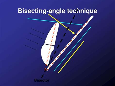 Bisecting angle technique