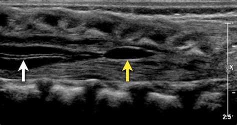 The Radiology Assistant : Ultrasound of the Neonatal spine