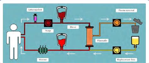 Therapeutic plasma exchange procedure. | Download Scientific Diagram