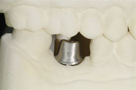 About Dental Implants | About Dental Implants - Kazemi Oral Surgery | Facialart.com