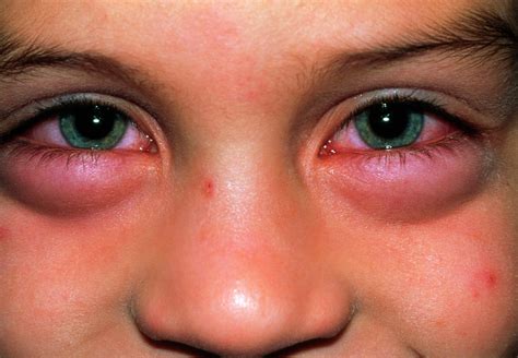 Child With Swollen Eyes From An Allergic Reaction Photograph by Dr P. Marazzi/science Photo Library