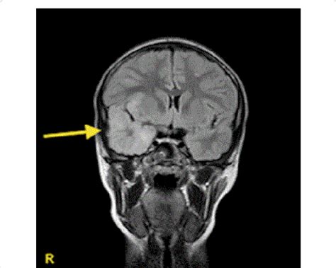 MRI (T2 FLAIR sequence) showing hyperintense signal in the right... | Download Scientific Diagram