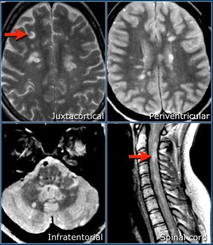 Pin by Lucy Ace on MS | Multiple sclerosis, Brain lesions, Radiology